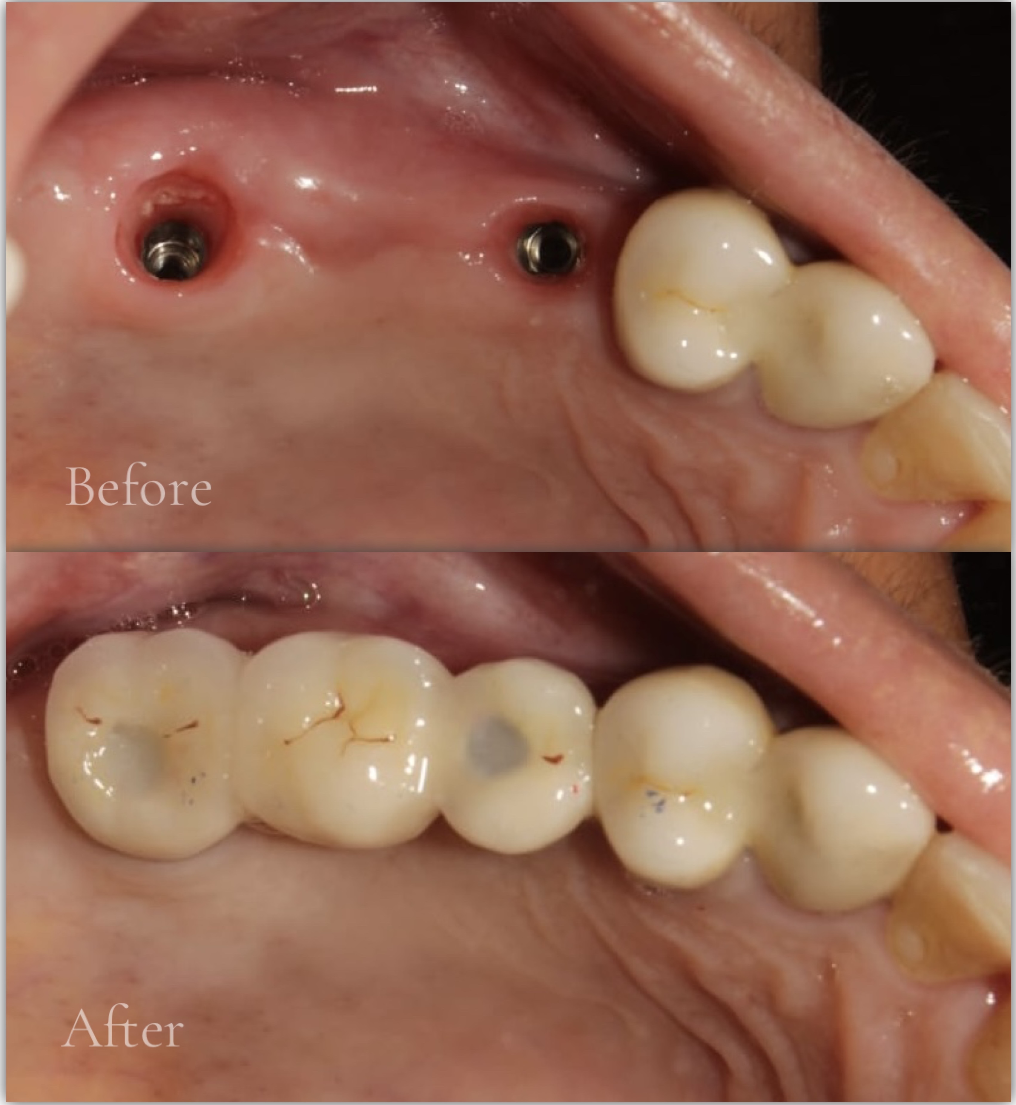 Multiple Missing Teeth Implants Before After