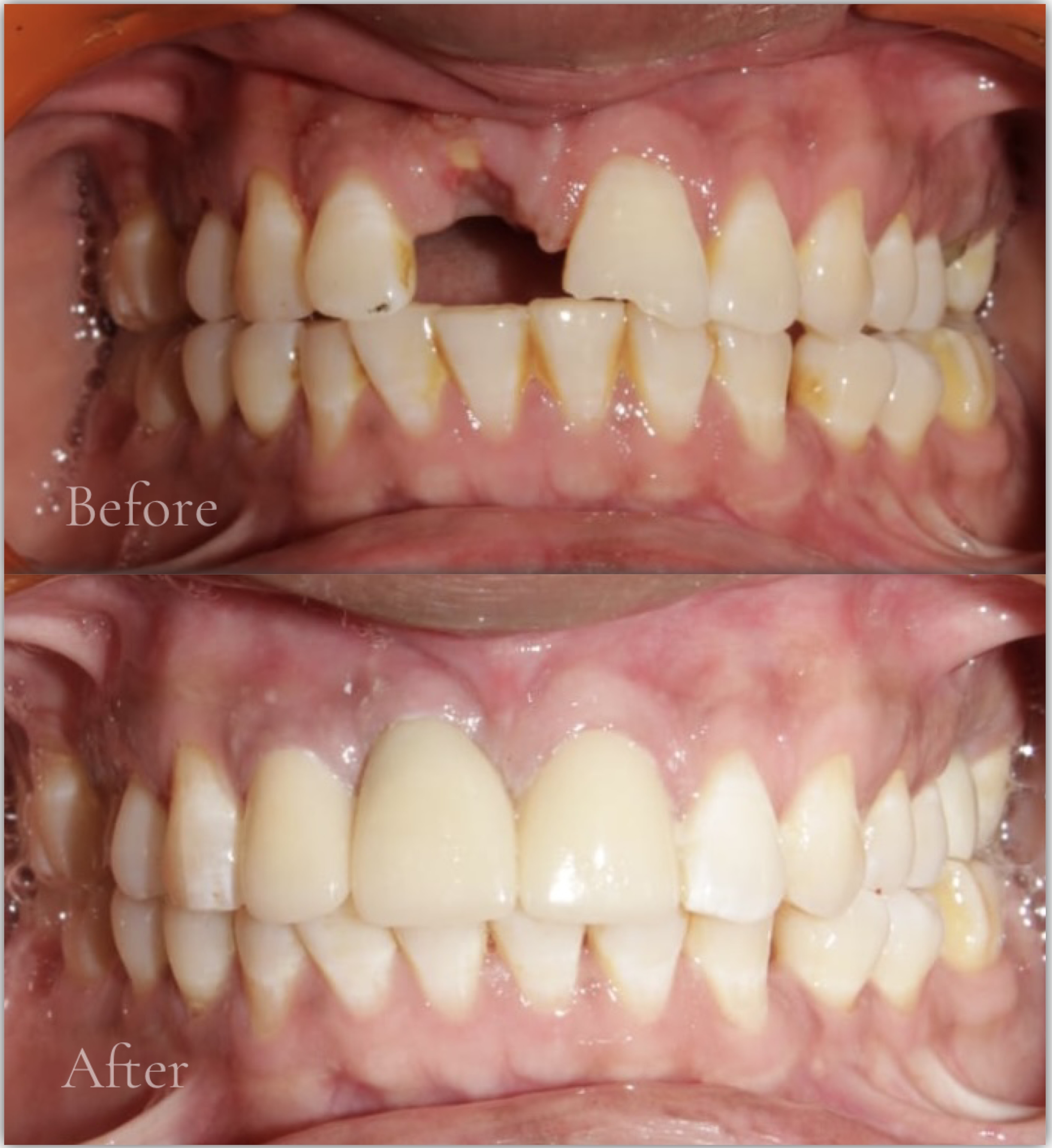 Single Missing Tooth Implant Before After